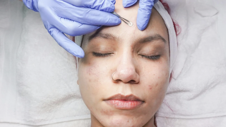 Acne Treatment Appointment in Leonardtown Maryland